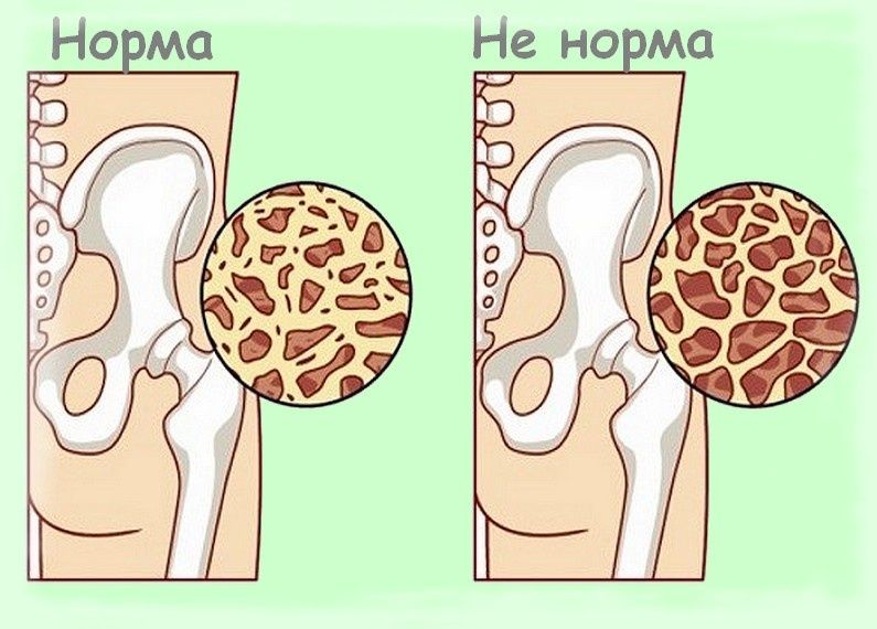 Что действительно укрепляет кости после 55 лет: выход за пределы традиционного подхода