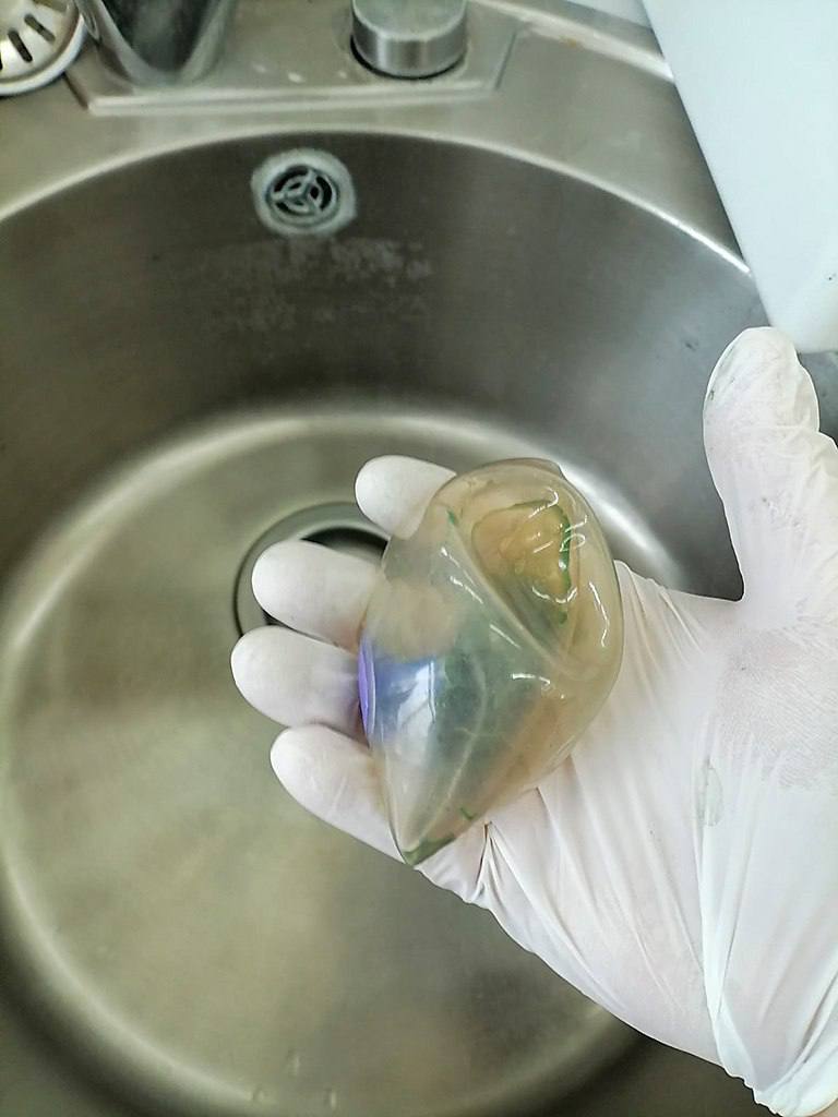 Баллон для похудения едва не стоил жизни пациентке в Находке Баллон для похудения едва не стоил жизни пациентке в Находке