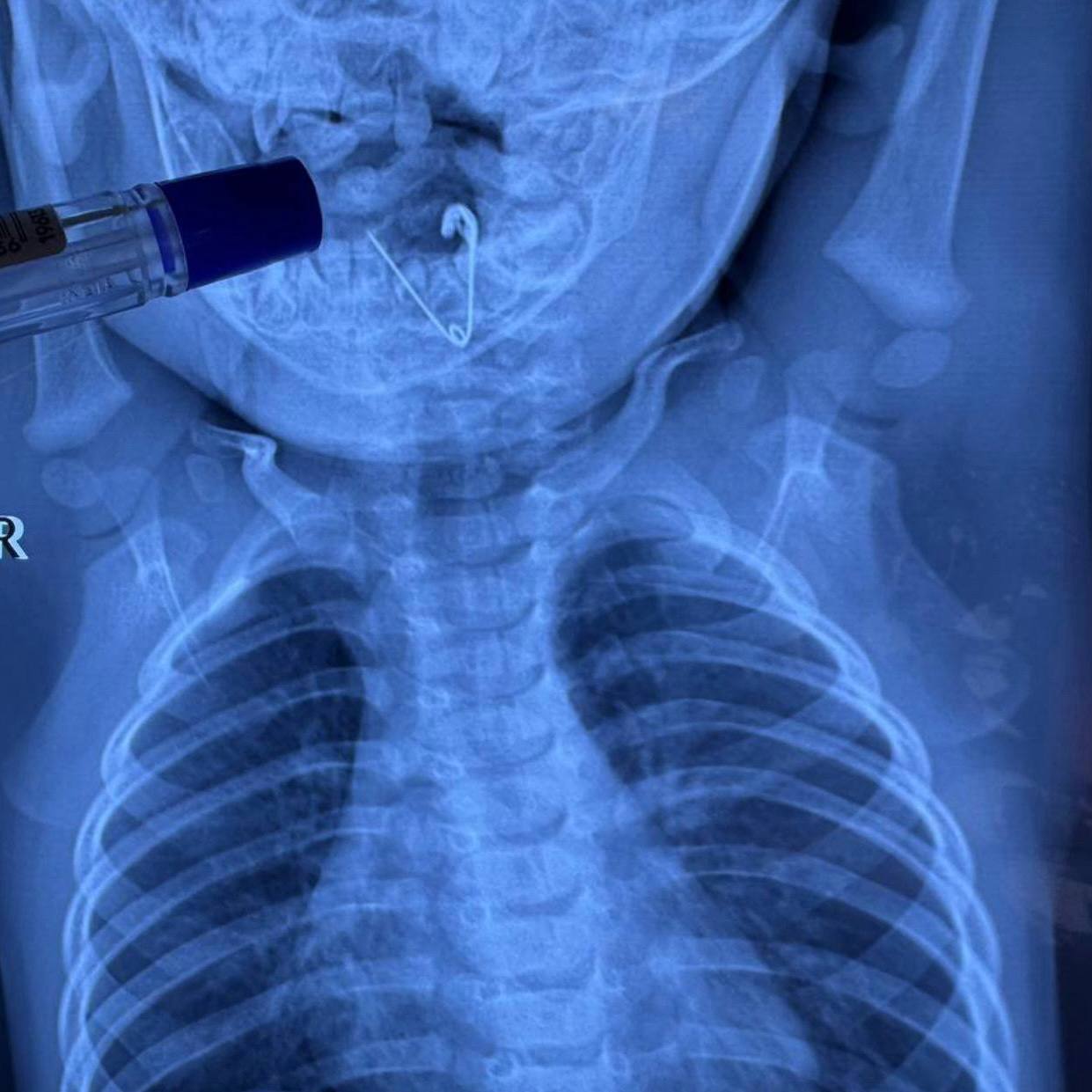 Приморские врачи спасли малыша, проглотившего булавку-оберег