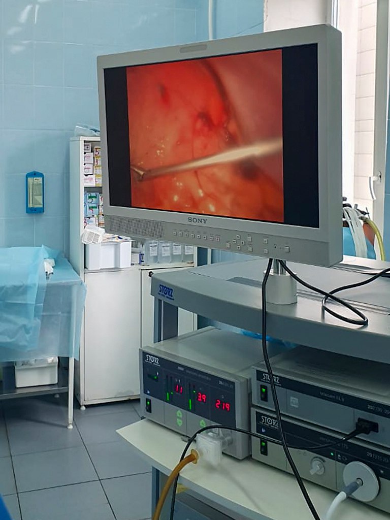 В Находкинской больнице врачи извлекли из желудка 35-летней пациентки баллон для снижения аппетита, который чуть не убил ее В Находкинской больнице врачи извлекли из желудка 35-летней пациентки баллон для снижения аппетита, который чуть не убил ее