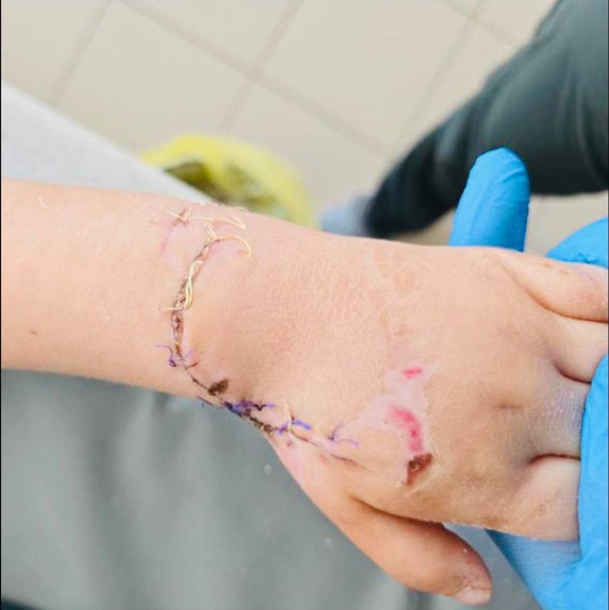 Врачи в Приморье спасли руку 4-летней девочки, которую зажевало в эскалатор Врачи в Приморье спасли руку 4-летней девочки, которую зажевало в эскалатор