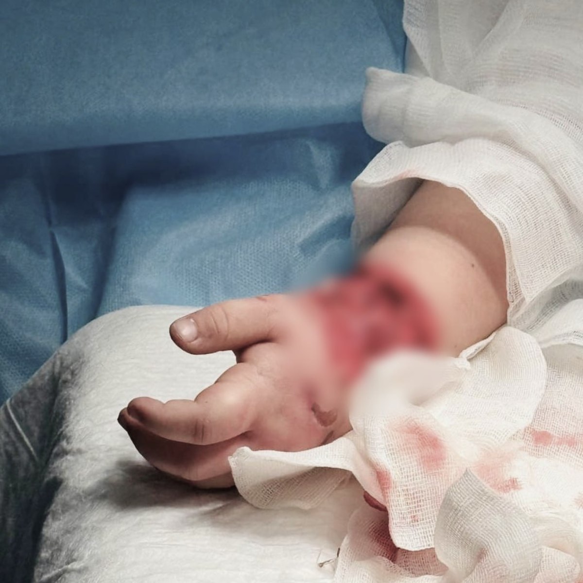 Врачи в Приморье спасли руку 4-летней девочки, которую зажевало в эскалатор