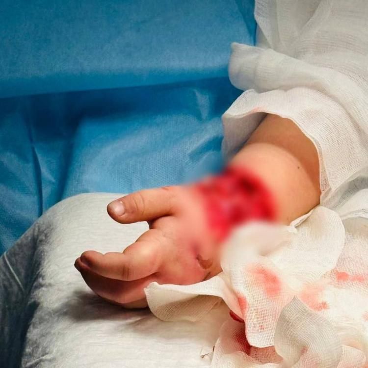 Во Владивостоке врачи успешно спасли руку четырехлетней пациентке
