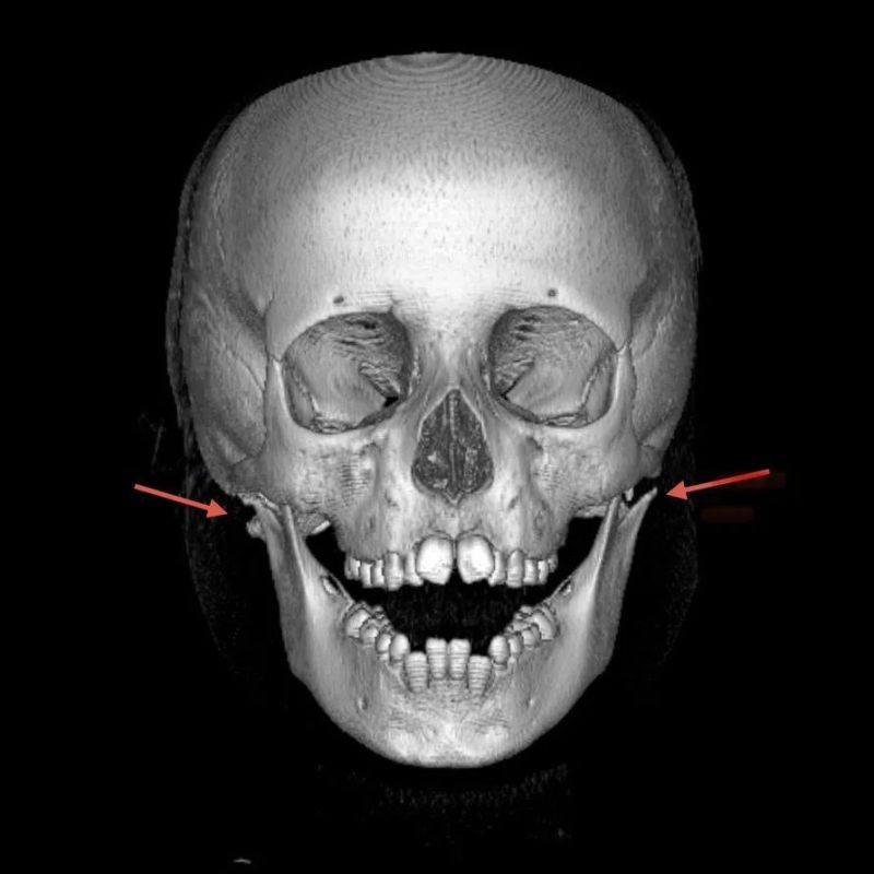Ребёнок в Фокино сломал челюсть, катаясь со снежной горки