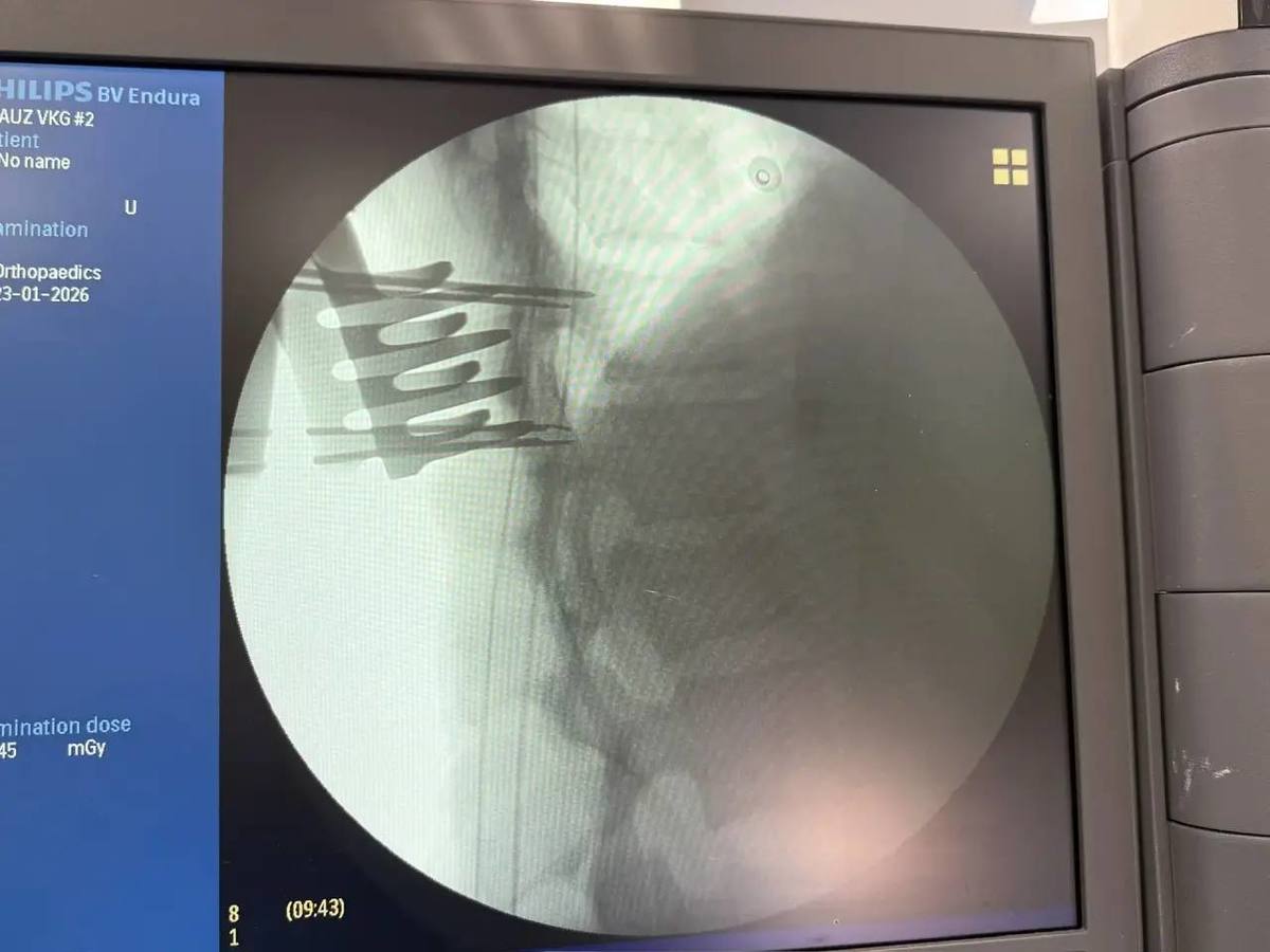 Нейрохирурги вернули способность ходить 18-летней лыжнице после падения на горнолыжке в Арсеньеве Нейрохирурги вернули способность ходить 18-летней лыжнице после падения на горнолыжке в Арсеньеве