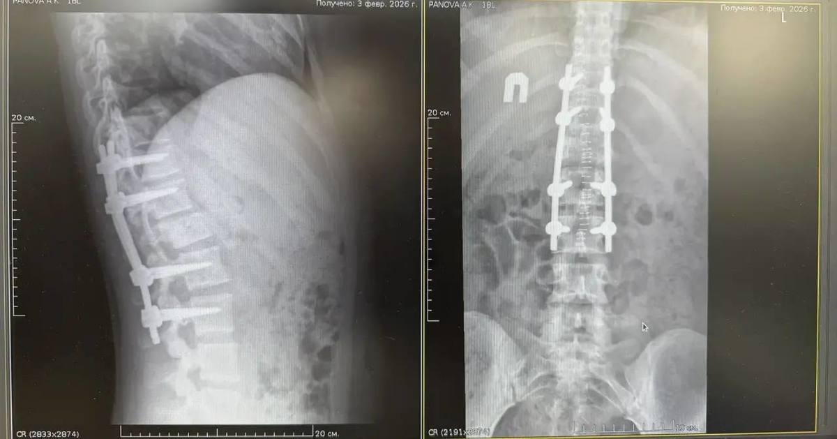 Нейрохирурги вернули способность ходить 18-летней лыжнице после падения на горнолыжке в Арсеньеве Нейрохирурги вернули способность ходить 18-летней лыжнице после падения на горнолыжке в Арсеньеве