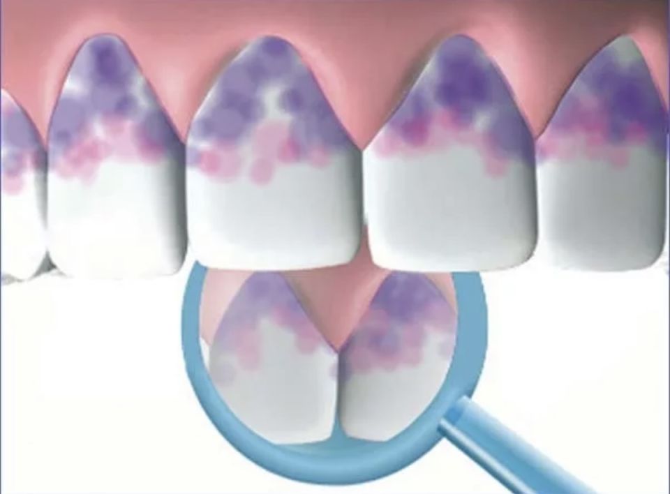 Индикаторы зубного налёта: полезный помощник для вашей улыбки