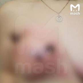 Жительница Тулы год прожила с салфеткой в груди — которую забыл внутри пластический хирург во время операции в питерской клинике