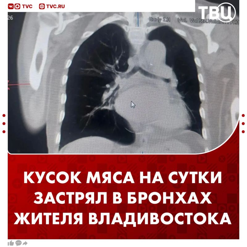 Житель Владивостока провел сутки с куском мяса в бронхах