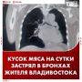 Житель Владивостока провел сутки с куском мяса в бронхах